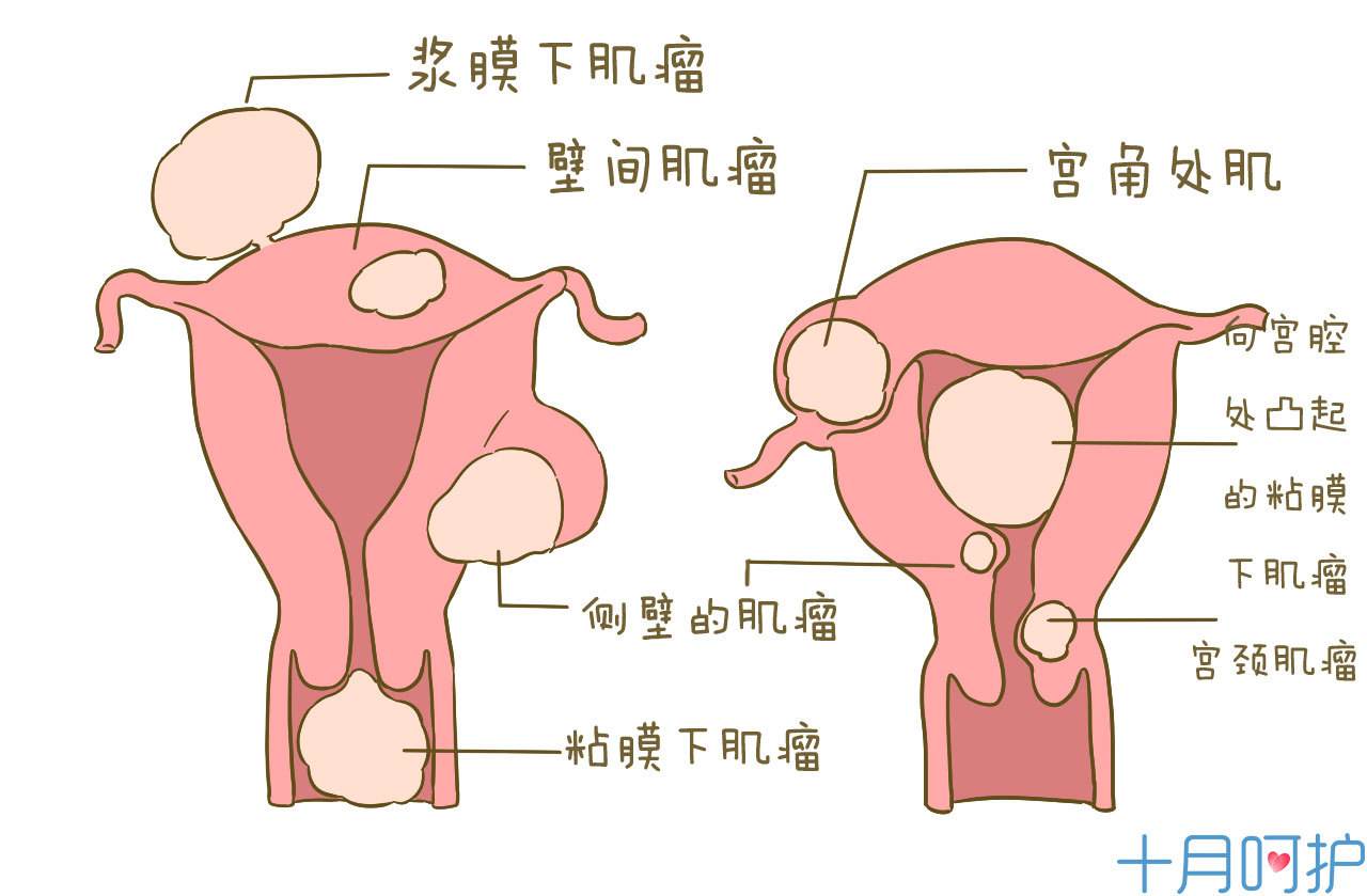 子宫肌瘤的4大致病因素，知道了不吃亏，特别是这3类女性